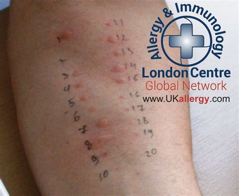 scratch test for allergy|allergy test allergic to everything.